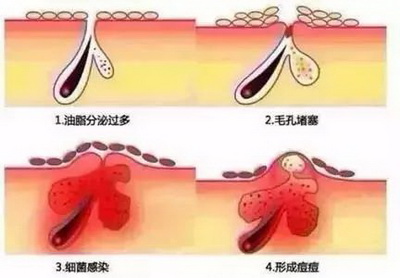 怎么才能彻底消除脸上的痘坑痘印